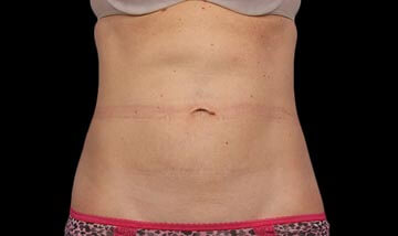 Coolsculpting Female Abdomen After