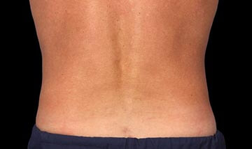 Coolsculpting Male Abdomen After
