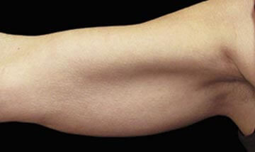 Coolsculpting Female Arms Before