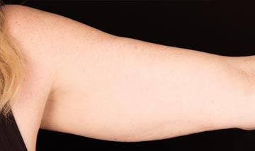 Coolsculpting Female Arms After