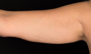 Coolsculpting Female Arms After