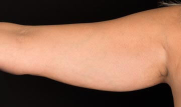 Coolsculpting Female Arms Before