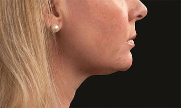 Coolsculpting Female Face After
