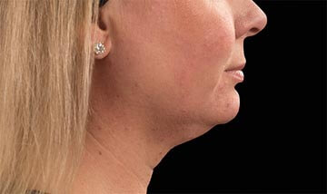 Coolsculpting Female Face Before