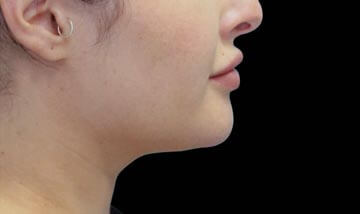 Coolsculpting Female Face After