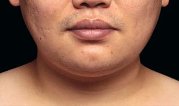 Coolsculpting Male Face After