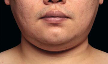 Coolsculpting Male Face Before