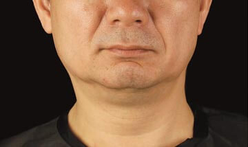 Coolsculpting Male Face After