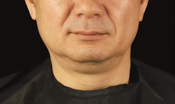 Coolsculpting Male Face Before