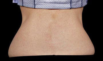 Coolsculpting Female Side After