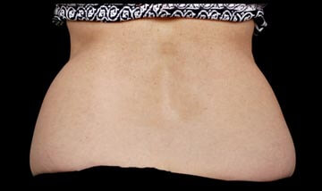 Coolsculpting Female Side Before