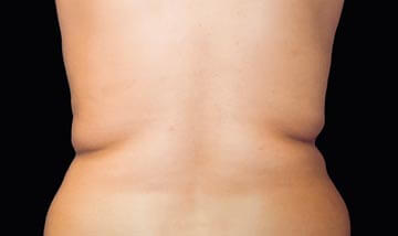 Coolsculpting Female Side Before