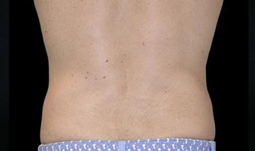 Coolsculpting Male Abdomen After