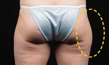 Coolsculpting Female Thights Before